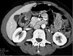 Antral Polyp - CTisus CT Scan