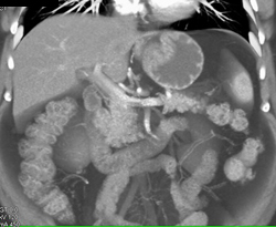 Gastric Adenocarcinoma - CTisus CT Scan