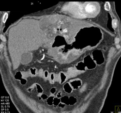 Hepatic Tumor Invades the Stomach - CTisus CT Scan