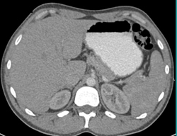 Normal Oral Omnipaque - CTisus CT Scan