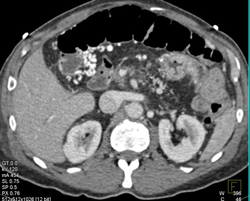 Carcinomatosis With Collaterals Around Gastric Antrum- Unusual Pattern - CTisus CT Scan