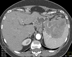 GIST Tumor - CTisus CT Scan