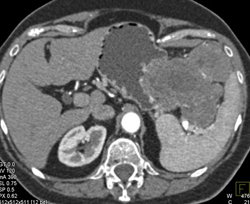 GIST Tumor - CTisus CT Scan