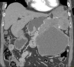 GIST Tumor - CTisus CT Scan