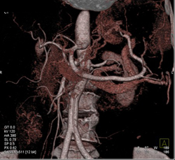 GIST Tumor - CTisus CT Scan