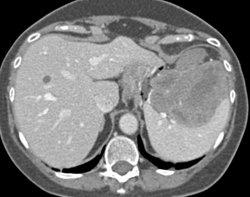 GIST Tumor - CTisus CT Scan