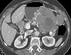 GIST Tumor - CTisus CT Scan