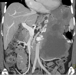 GIST Tumor - CTisus CT Scan