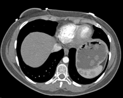 Gastric Polyps in Familial Polyposis - CTisus CT Scan