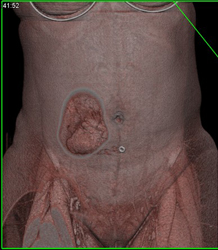 Desmoid in Same Patient in Abdominal Wall - CTisus CT Scan