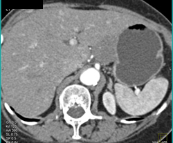 Gastric Adenocarcinoma - CTisus CT Scan