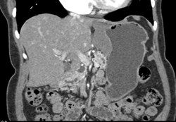 Gastric Cancer at Gastroesophageal (GE) Junction - CTisus CT Scan