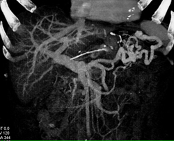 Gastric Varices in Portal Hypertension - CTisus CT Scan