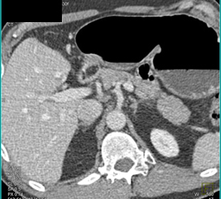 Lipoma in Antrum - CTisus CT Scan