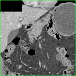 Gastro-jejunostomy - CTisus CT Scan