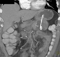 Catheter From Stomach Into Pseudocyst - CTisus CT Scan