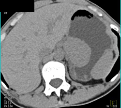 GIST Tumor - CTisus CT Scan