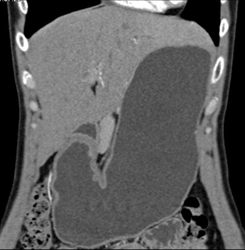 Antral Outlet Obstruction Due to Gastric Antral Adenocarcinoma - CTisus CT Scan