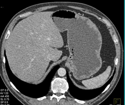 Subtle Gastric Adenocarcinoma on Bx - CTisus CT Scan