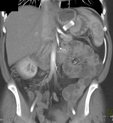 Banding for Weight Loss With Retained Pills in Stomach - CTisus CT Scan