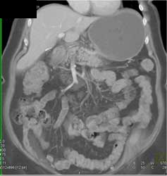 Antral Carcinoma - CTisus CT Scan