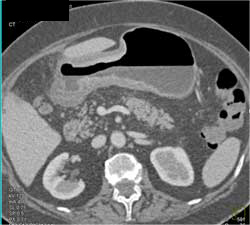 Antral Carcinoma - CTisus CT Scan