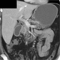 Post Gastric Resection - CTisus CT Scan