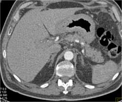 Linitis Plastica - CTisus CT Scan