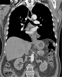 Linitis Plastica - CTisus CT Scan