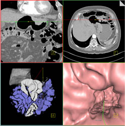 Gastric Cancer With Endoscopic View - CTisus CT Scan