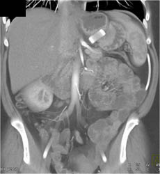 Gastric Banding Procedure With Inflatable Band - CTisus CT Scan