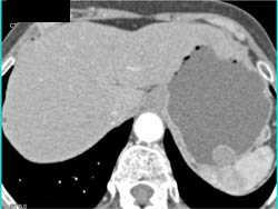 GIST Tumor - CTisus CT Scan