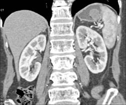 GIST Tumor - CTisus CT Scan