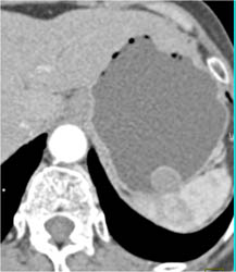 GIST Tumor - CTisus CT Scan