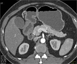 Antral Carcinoma - CTisus CT Scan