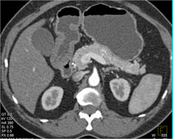 Antral Carcinoma - CTisus CT Scan