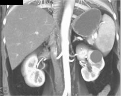 Duodenal Cancer - CTisus CT Scan