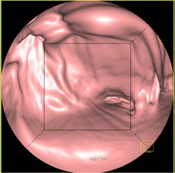 Antral Carcinoma in 3D - CTisus CT Scan