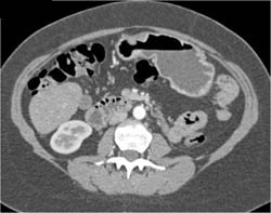 Antral Cancer - CTisus CT Scan