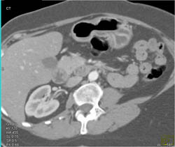 Antral Cancer - CTisus CT Scan