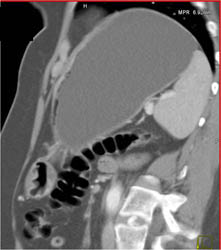 Antral Cancer - CTisus CT Scan