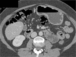 Antral Cancer - CTisus CT Scan