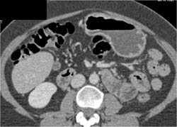 Antral Cancer - CTisus CT Scan