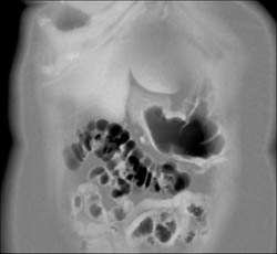 Antral Cancer - CTisus CT Scan