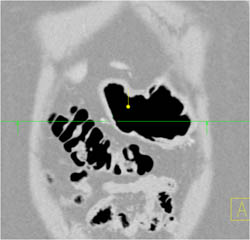 Antral Cancer - CTisus CT Scan