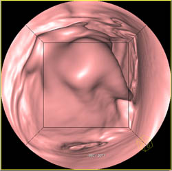 Antral Cancer - CTisus CT Scan