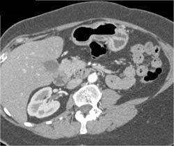 Antral Cancer - CTisus CT Scan