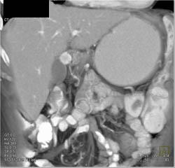 Vascular Lesion in Duodenum- Carcinoid - CTisus CT Scan