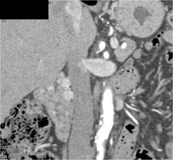 Multiple Vascular Tumors in Duodenum and Stomach - CTisus CT Scan