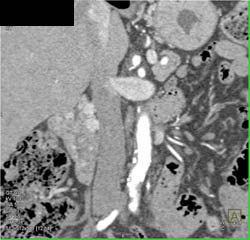 Multiple Vascular Tumors in Duodenum and Stomachmultiple Vascular Tumors in Duodenum and Stomach - CTisus CT Scan